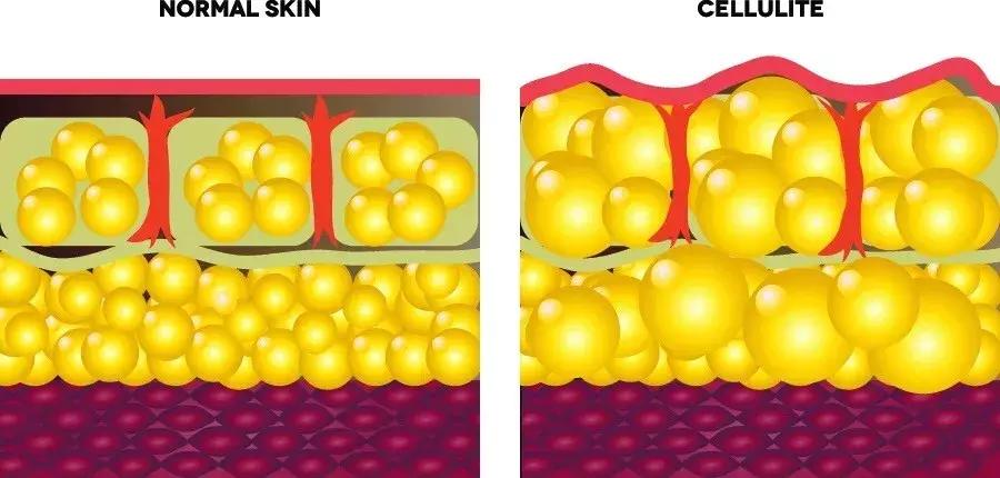 鸡皮肤留下的疤痕怎么消除,橘皮纹鸡皮肤怎么去除