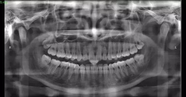 牙齿矫正全过程都在这里了,牙齿矫正一定要知道的事儿