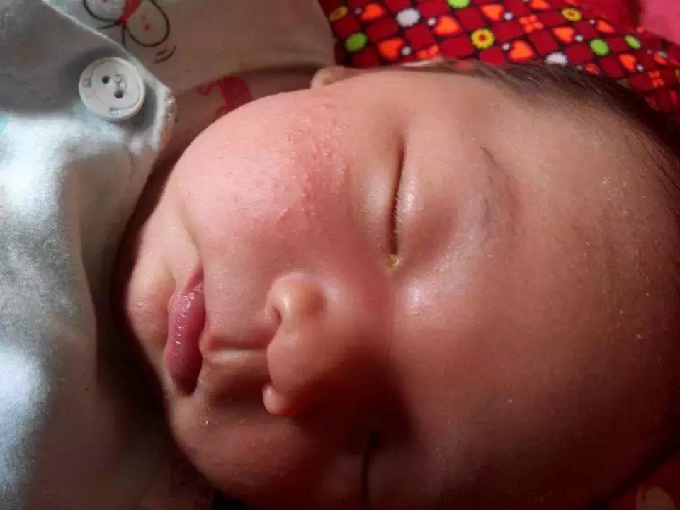 小儿热疹,小儿热疹用什么药好得快