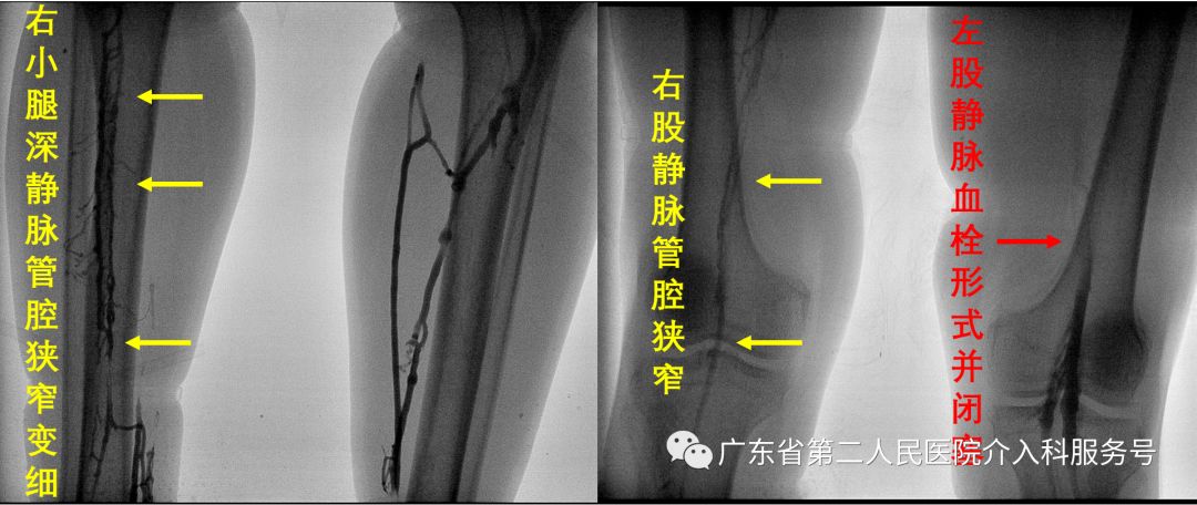 左腿血栓的最快消除方法,左腿浮肿有血栓用什么药治疗