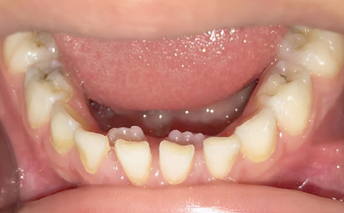 儿童换牙期常见牙齿问题,小朋友换牙新牙已出旧牙没松咋办