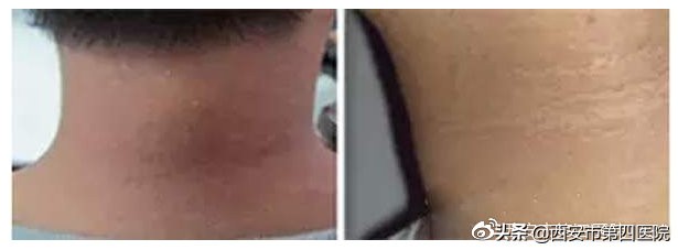 脖子发黑怎么都洗不干净怎么办,脖子发黑洗不掉像脏兮兮怎么办