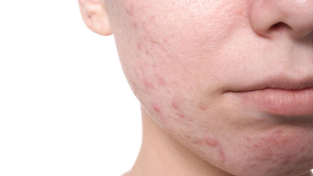 脸上反复长脓痘中医,脸上长了化脓的痘痘怎么处理