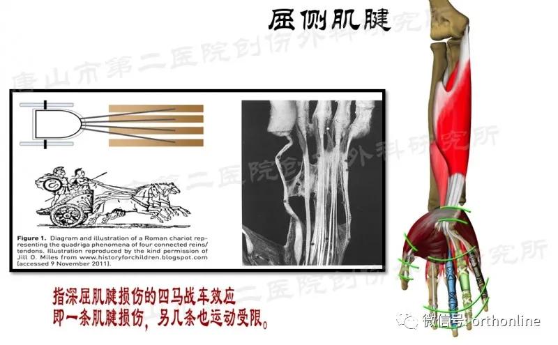 手部肌腱不完全断裂能完全复原吗,手部屈指肌腱损伤最难处理的部位