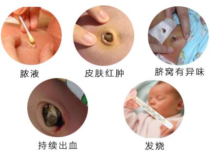 新生儿脐带一个月还没脱落正常吗,新生儿脐带一个月还没掉正常吗