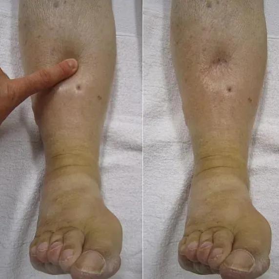 感觉身体水肿了是怎么回事？