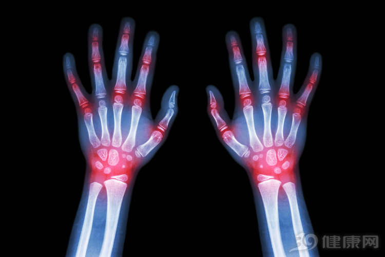 痛风跟风湿的区别中医,如何鉴别痛风和风湿