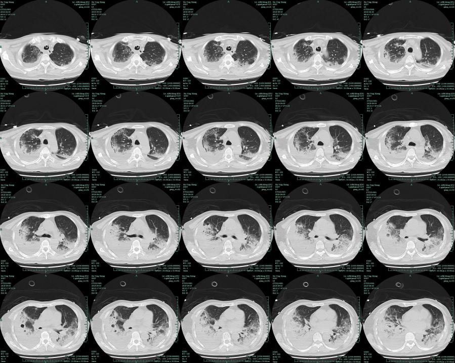 mngs病原检测的优势,mngs真的可靠吗