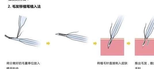 孕睫术睫毛真的能长长吗,睫毛孕睫术效果怎么样