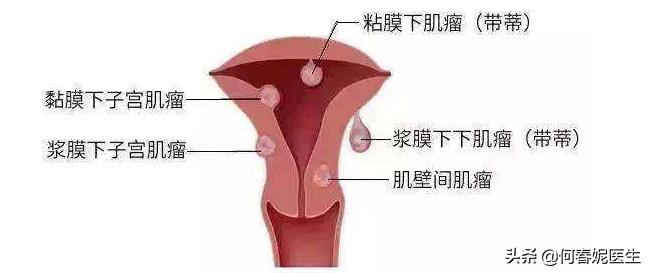 发现子宫肌瘤怎么办？该如何阻止其恶变行为？