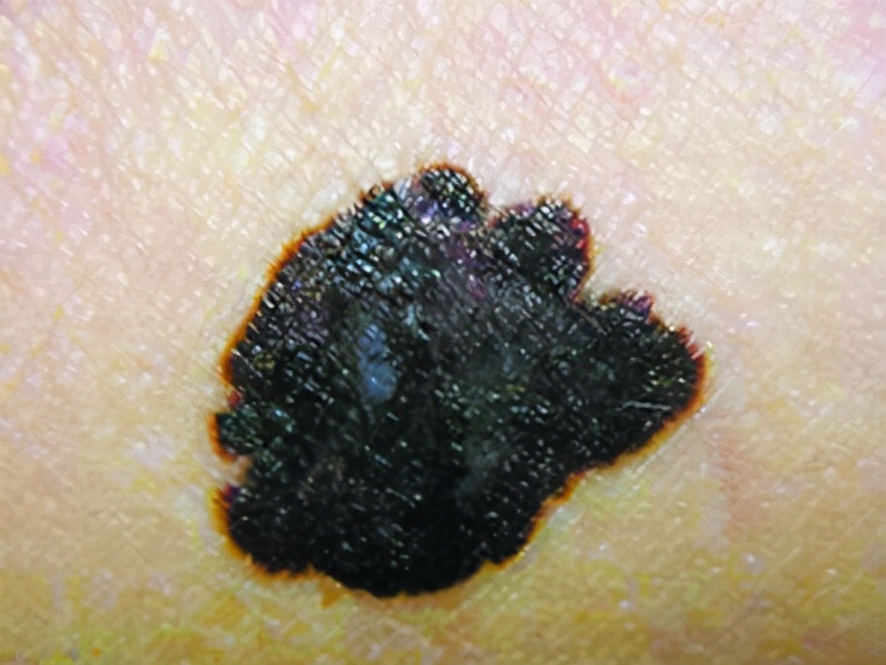 身上的痣发生癌变的症状,莫名其妙的痣可能是癌症信号