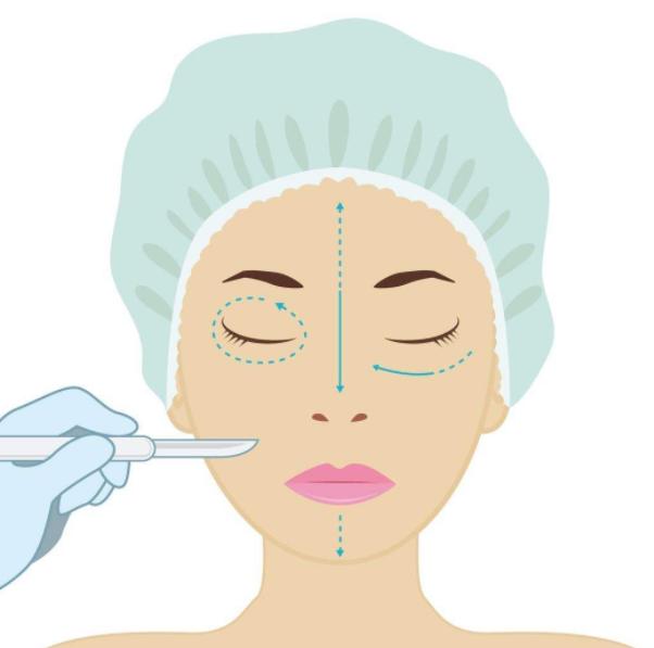 双眼皮术后长期未消肿，是失败了吗？