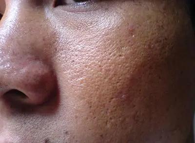 毛孔粗大真实修复对比,毛孔粗大拯救全过程