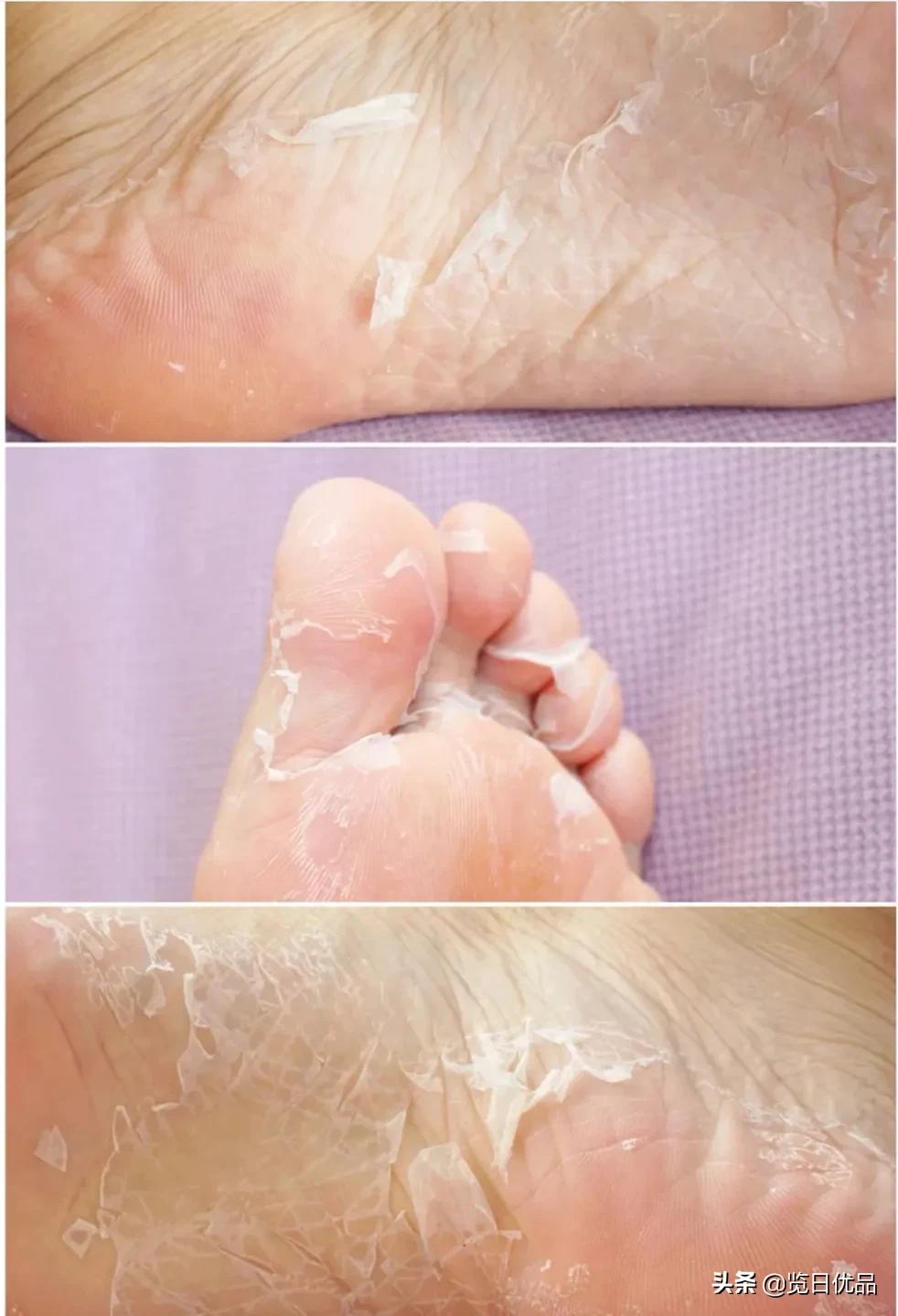 爽炸了!干丑裂的脚皮,一张完整撕掉,敢跟婴儿比姣嫩!
