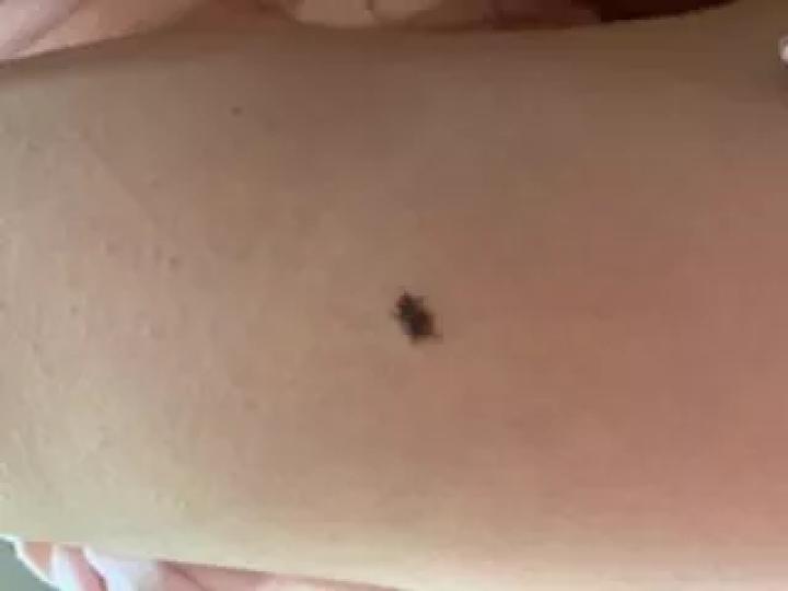 哪些部位长痣预示一生劳碌,痣的位置预示着什么