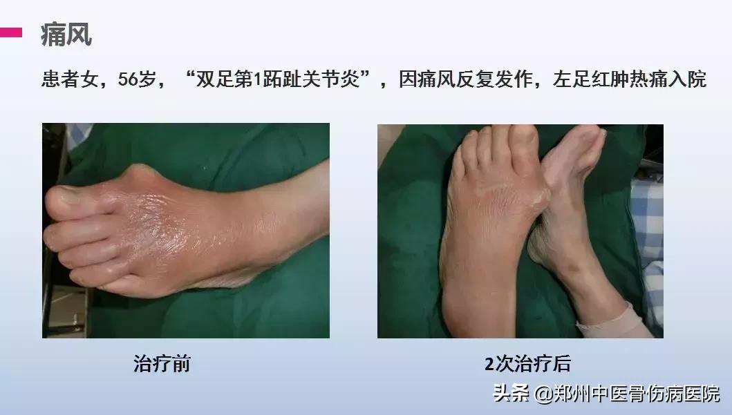 痛与不痛只差一个“低温”的距离—我院最新引进低温冲击疗法！