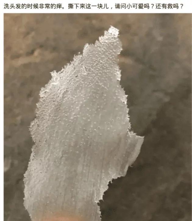 洗头发的时候很痒怎么办,为什么洗头发撕下来很痒