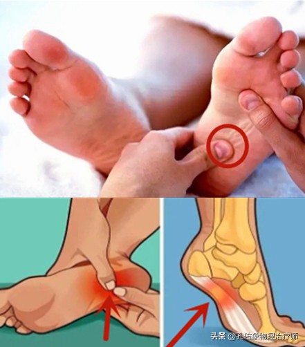如何治疗足底筋膜炎缓解疼痛,足跟痛筋膜炎最佳的治疗办法