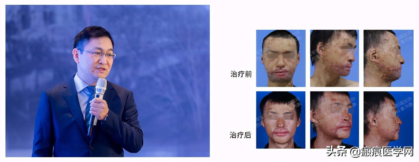 鐦㈢棔妗堜緥,鐤ょ棔娌荤枟鎴愬姛妗堜緥