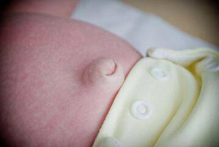 新生宝宝肚脐凸出来了怎么办,新生儿一个月肚脐眼会鼓起来吗