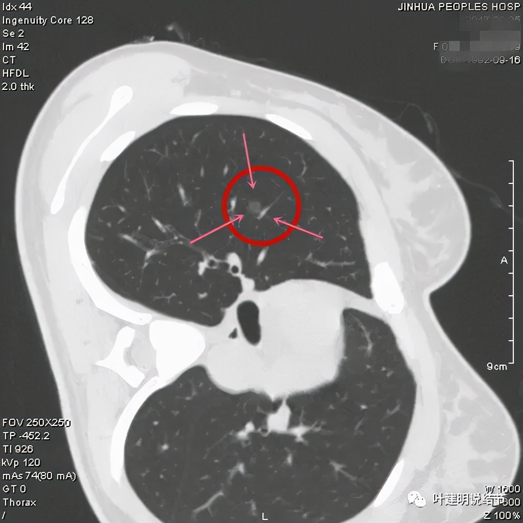 从活检怎么看是非小细胞癌,从病例谈辨证论治