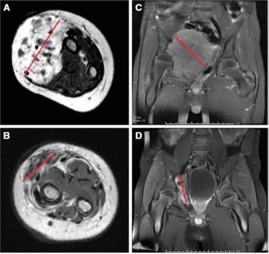 国际最新针对肿瘤的治疗,美国fda新药申请的途径