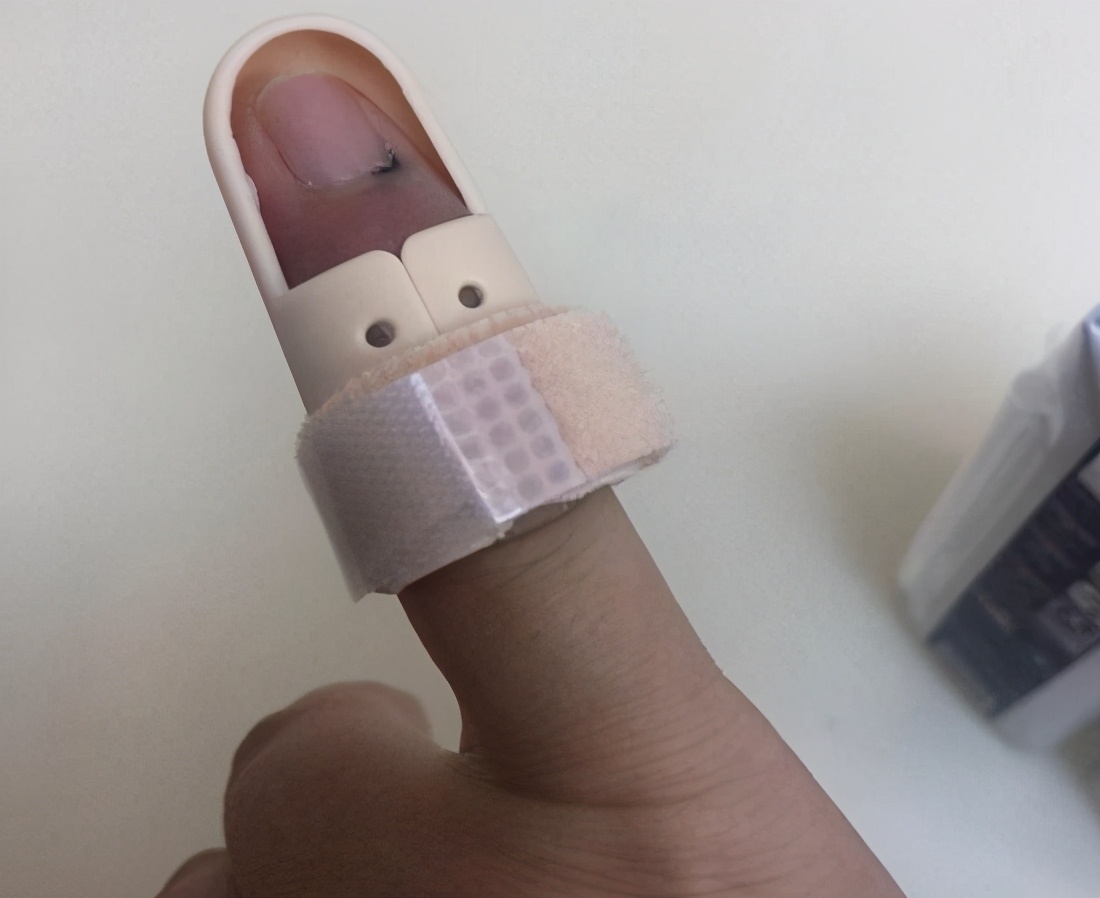 手指肌腱康复训练100个视频,手指肌腱术后康复训练最佳方法