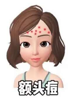 鼻翼两侧和下巴长痘什么原因引起,脸颊两边长痘是什么原因该怎么办