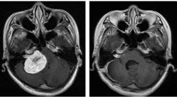 全国治疗鼻咽癌排行榜,鼻咽癌全球发病率最高的地区是