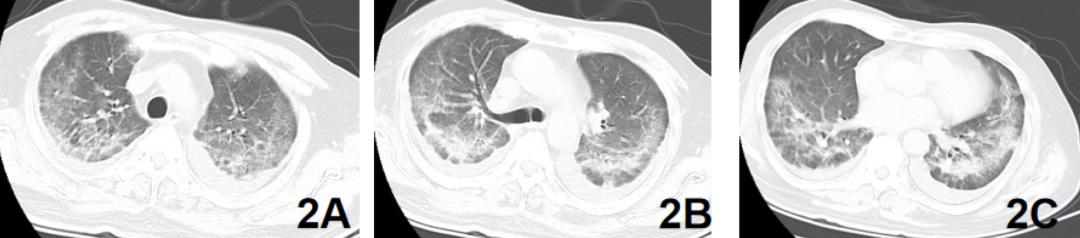 新冠症状容易与常见疾病症状混淆,症状和新冠一样怎么办