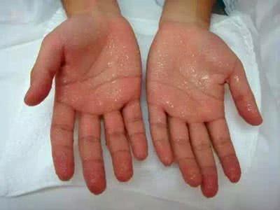 宝宝体虚出汗怎么食疗,身体这些部位出汗是大病