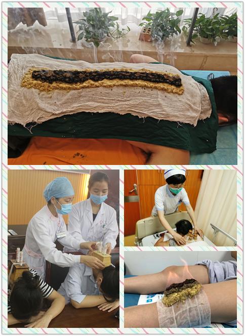 初伏锻炼养生,十五个专科齐上阵辨证施灸是关键