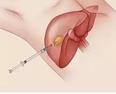 发现肝部有小结节用治疗吗,发现肝脏结节要做哪些检查