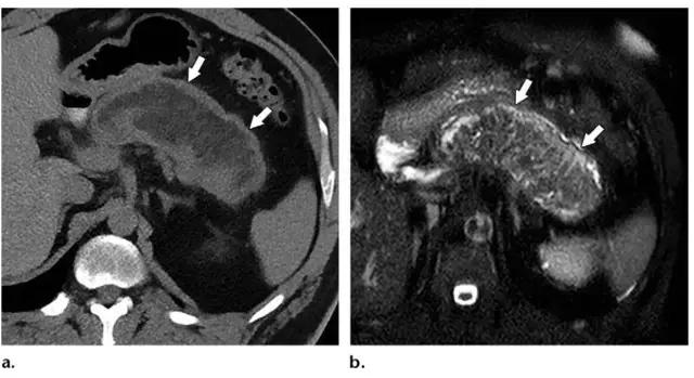 急性胰腺炎影像检查首选,急性坏死胰腺炎影像