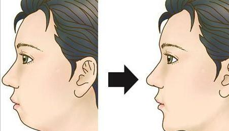 尖下巴女人的脸型,最新的隆下巴方式