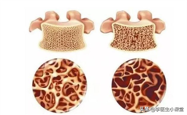 出现这3种症状你被骨质疏松盯上,骨质疏松有哪些症状就要赶快治疗