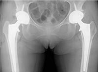 人工关节置换术适应症,关节置换术微创