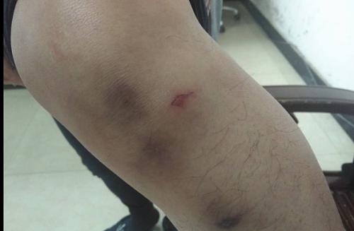 路面坑不平骑车人摔伤,因为路有坑骑车摔跤了