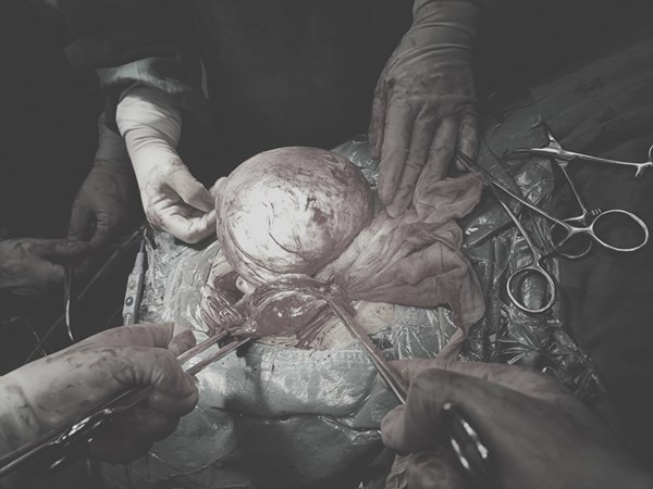 「援黔日记」成功切除5斤巨大子宫颈肌瘤