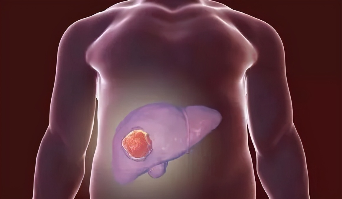 微创手术能根治肝癌,肝癌微创消融手术效果好吗知乎