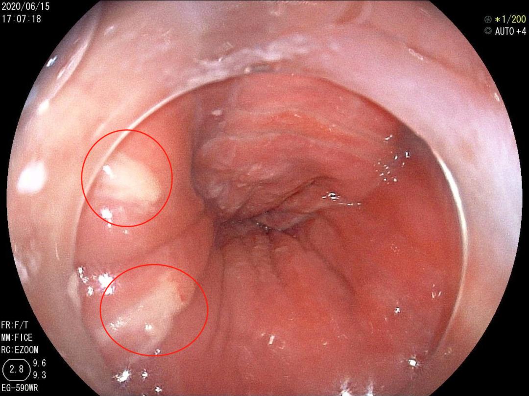 食堂吃到针头,饭菜吃进喉咙的时候感觉有点抵触