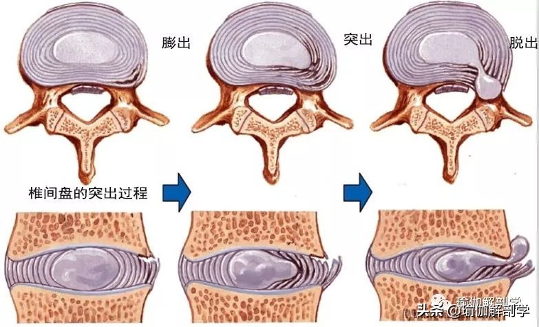 腰椎间盘突出适合练瑜伽哪些动作,腰椎间盘突出做什么瑜伽可以恢复