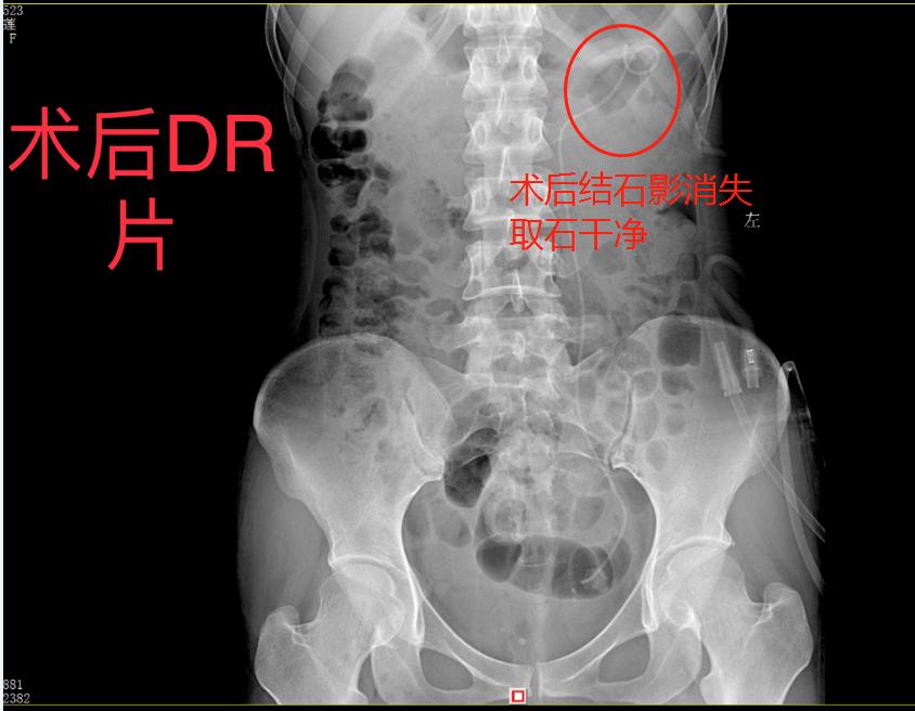肾盏憩室结石形成原因,肾盏憩室结石自行能排出吗