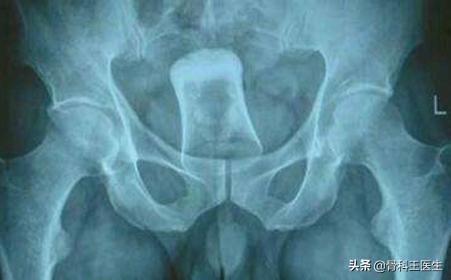 为什么会把异物塞进尿道,为什么会有人往尿道里塞异物