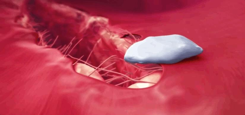 血小板破裂是什么意思,血小板凝固原因