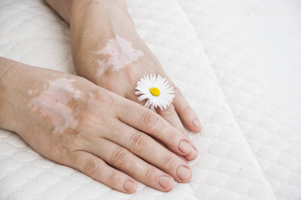 被误解的白化病：会传染？和白癜风一样？不能结婚生小孩？