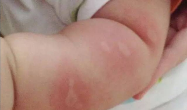 孕妇蚊子咬了可以用双飞人药水吗,孕妇被蚊子咬止痒小妙招