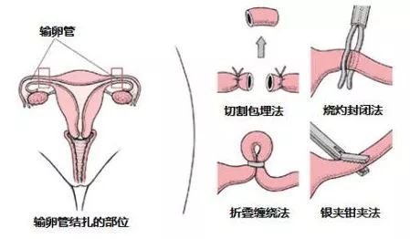 男人结扎会影响肾吗,男人结扎有什么影响和什么好处
