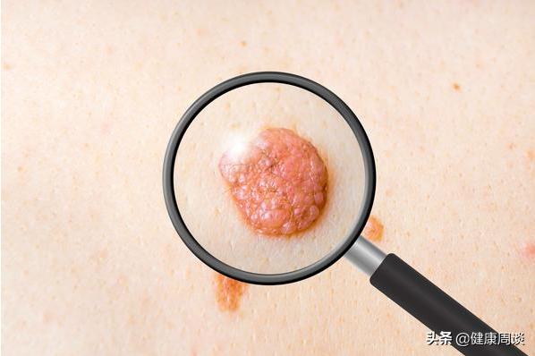 身上突发的肉疙瘩是瘤？会癌变？医生：或与5种疾病有关，需留意