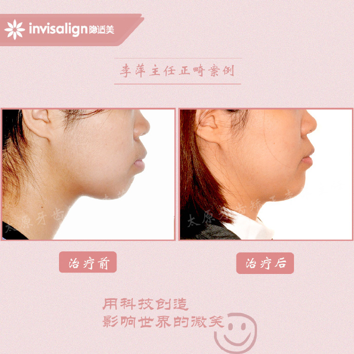 龅牙矫正牙齿能解决下颌后缩么,儿童正畸能解决鼻基底凹陷问题吗